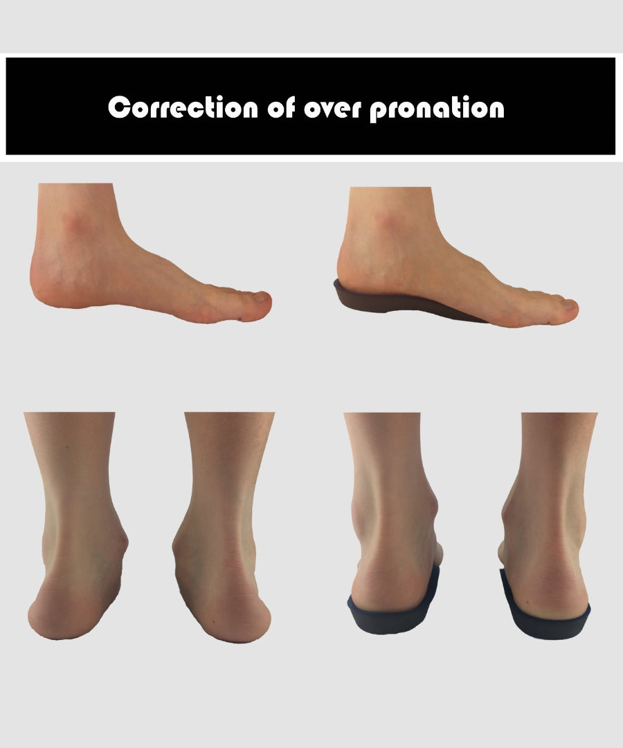 Over pronation deals insoles australia